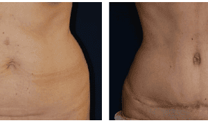 Abdominoplastia braquioplastia   cruroplastia