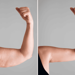 Lipoescultura lipo brazos lipo muslos ginecomastia