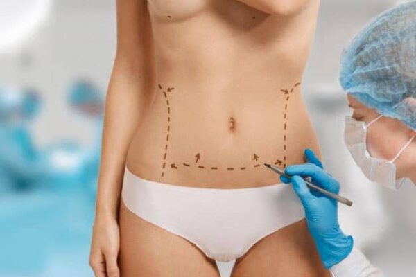 Lipoescultura lipo brazos lipo muslos ginecomastia